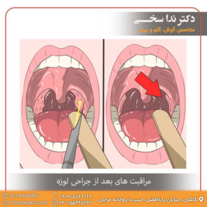 مراقبت های بعد از جراحی لوزه