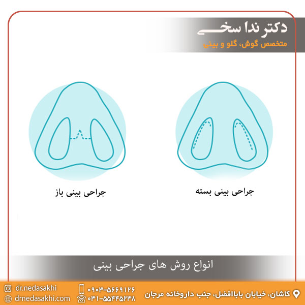 انواع روش های جراحی بینی