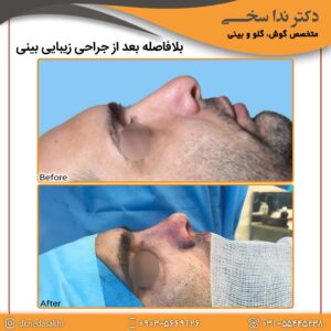 جراحی بینی نیمه فانتزی