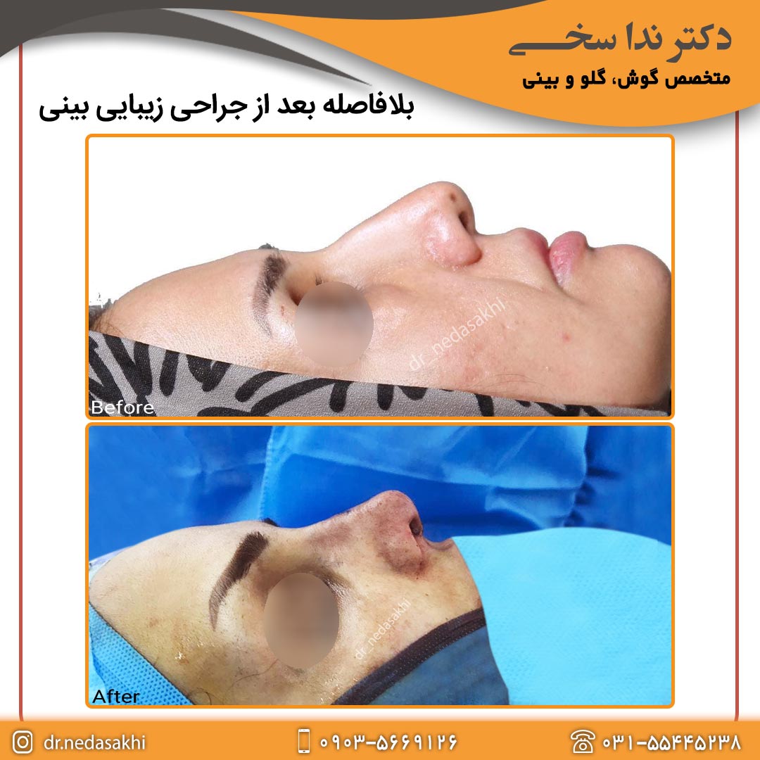 جراحی بینی نیمه فانتزی 1