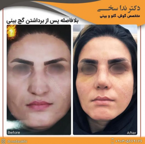 اسپلینت بینی- دکتر ندا سخی 2