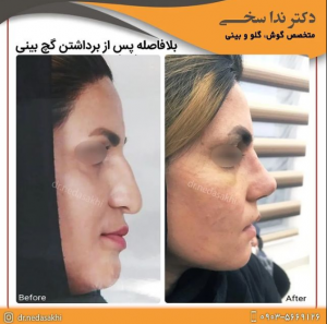 اسپلینت بینی - دکتر ندا سخی