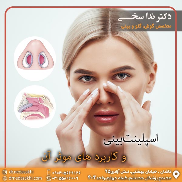 اسپلینت بینی - دکتر ندا سخی 3