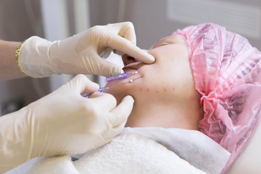 لیفت گونه با نخ