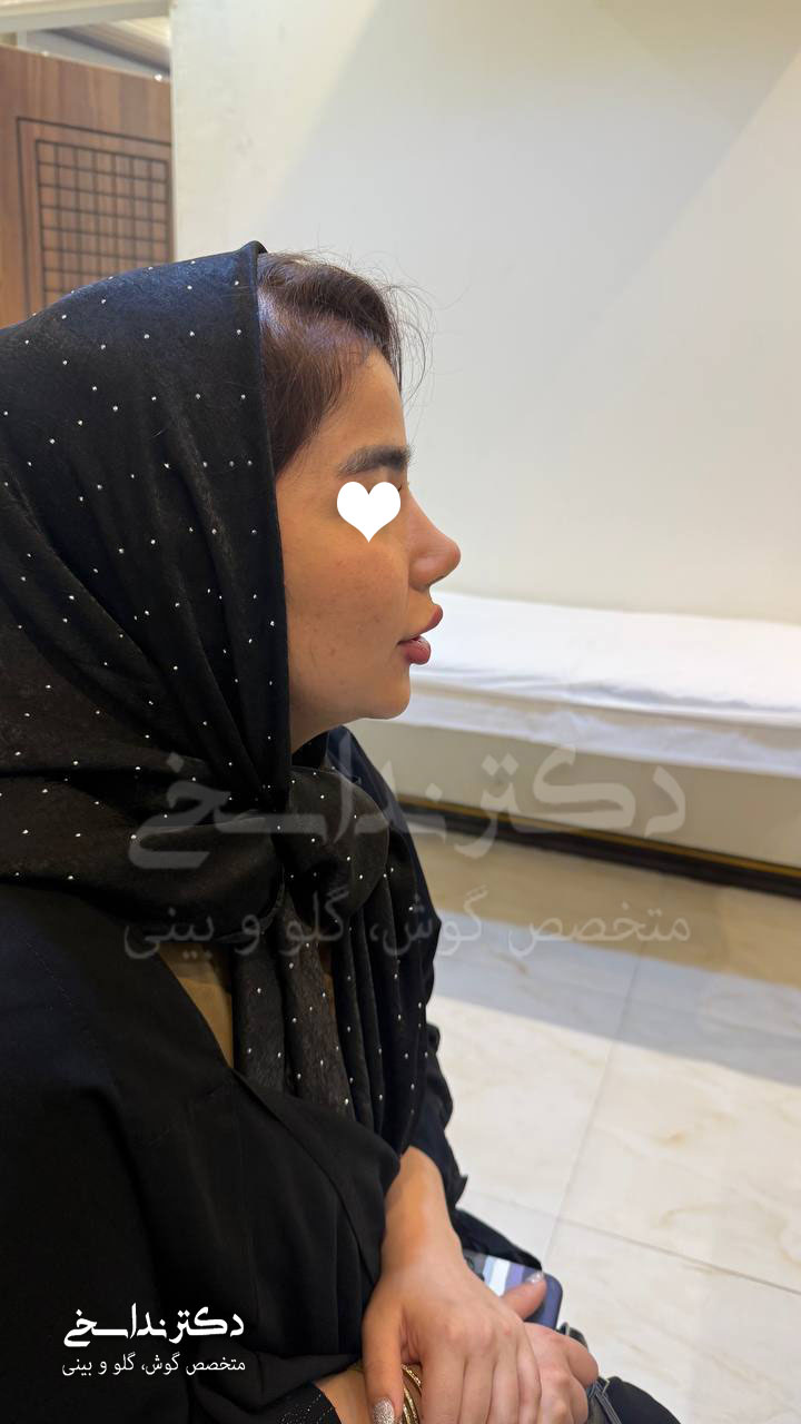 بعد از جراحی بینی