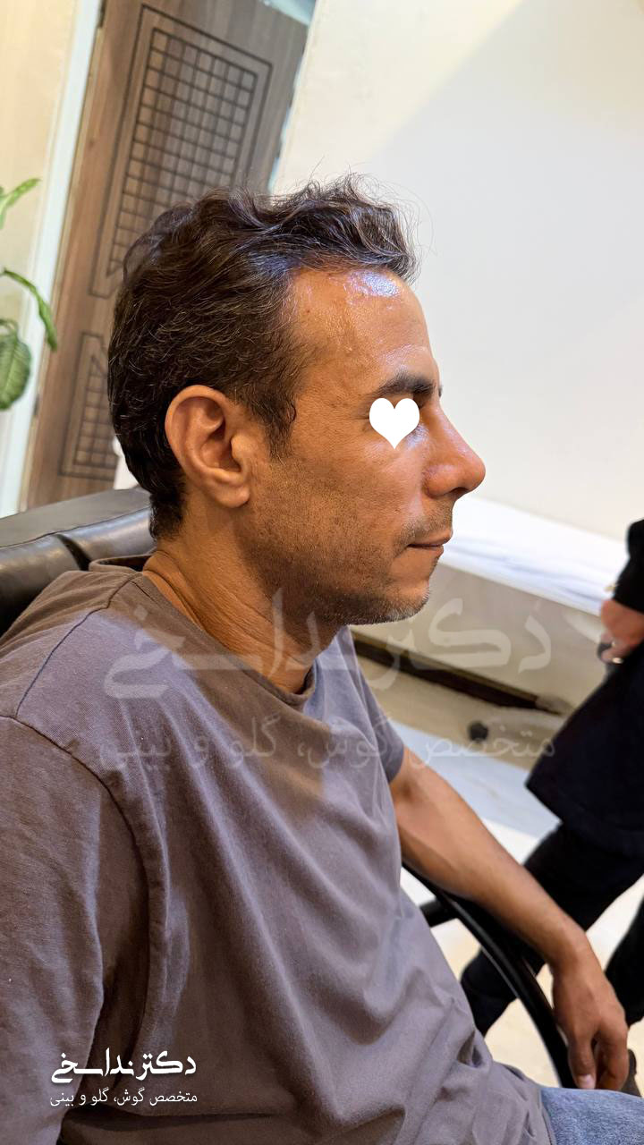 شش ماه پس از جراحی بینی