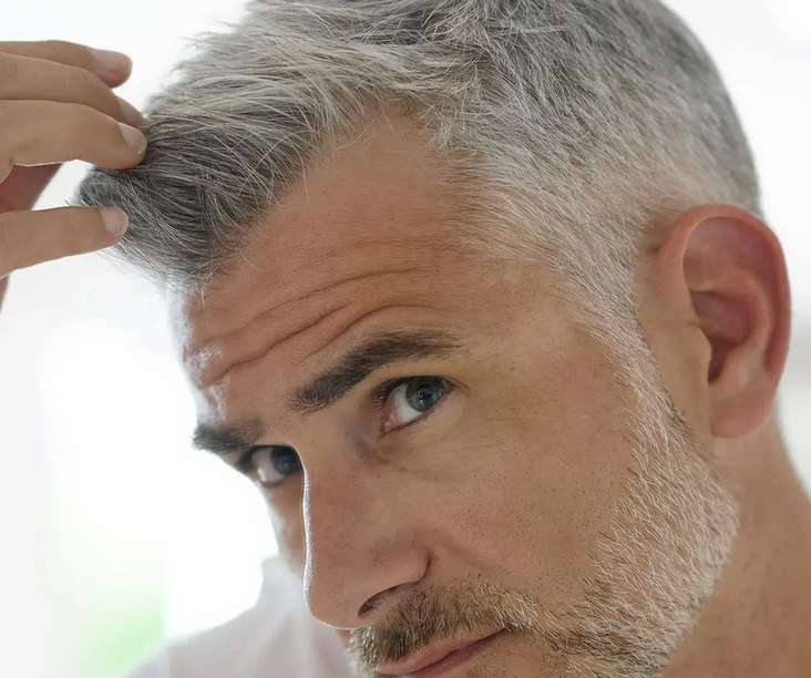 ریزش مو بعد از کاشت مو