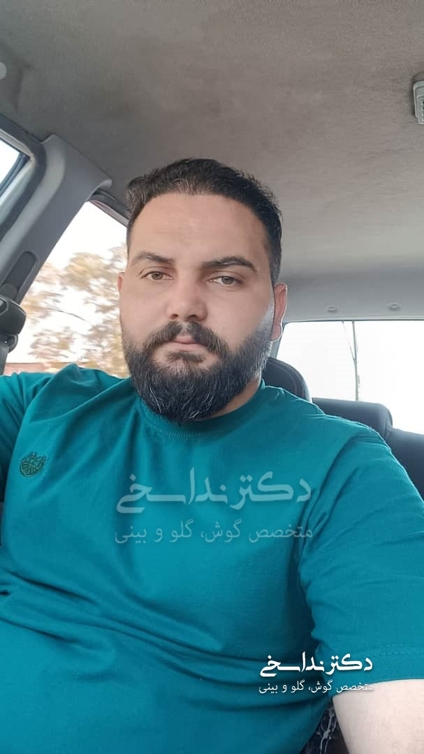کاشت مو