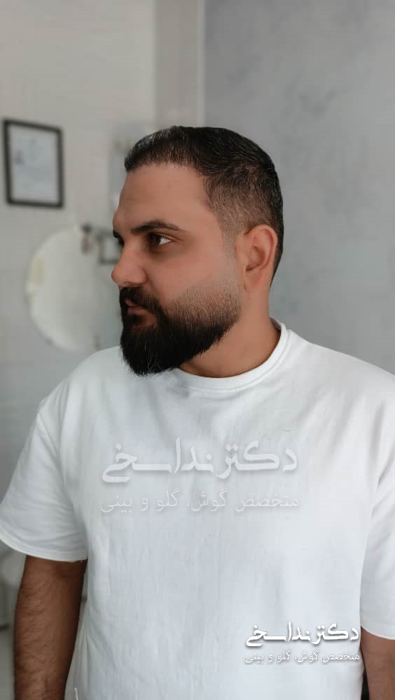 چند ماه پس از جراحی بینی