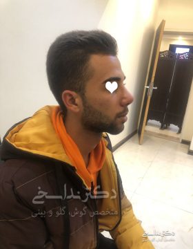 چند ماه پس از جراحی بینی