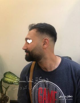 چند ماه پس از جراحی بینی