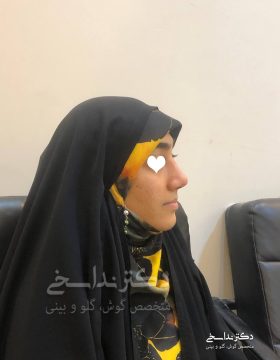 چند ماه پس از جراحی بینی