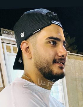 چند ماه پس از جراحی بینی