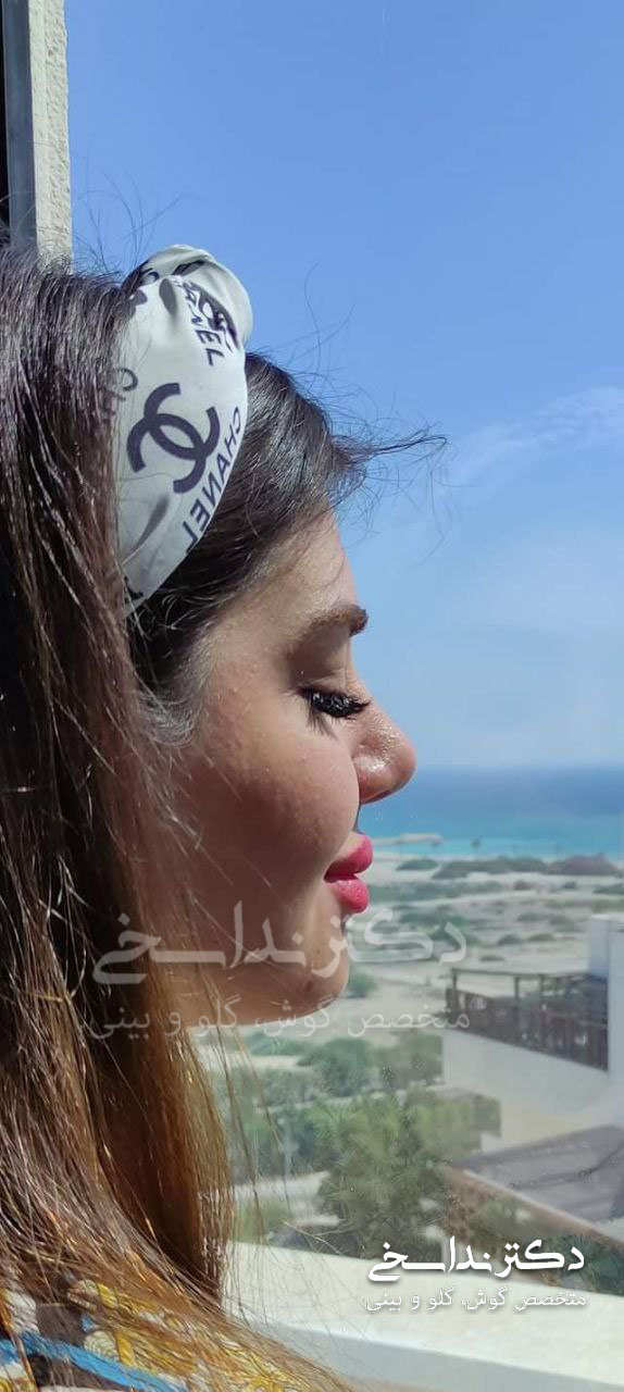 چند ماه بعد از عمل بینی