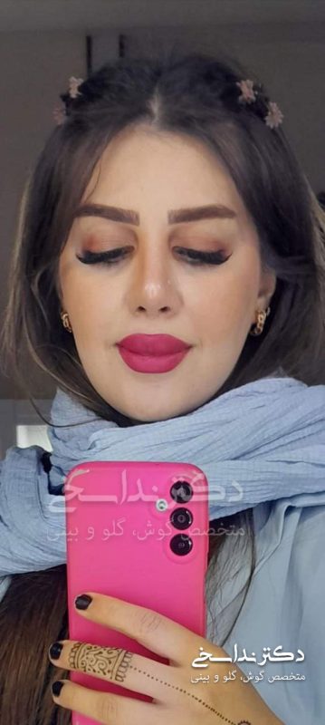 چند ماه بعد از عمل بینی