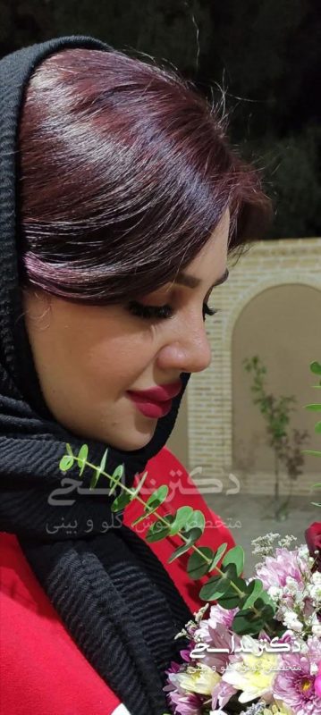 چند ماه پس از جراحی بینی