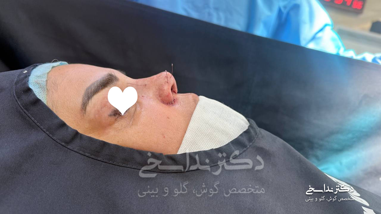 جراحی بینی ترمیمی کاشان