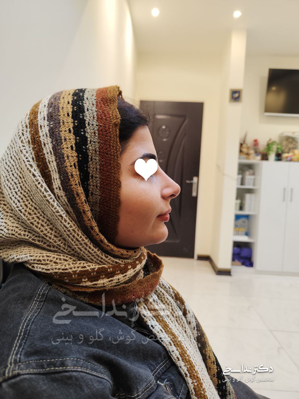 بعد از عمل بینی