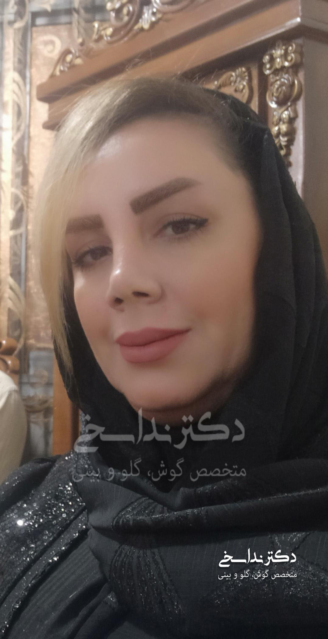 چند ماه پس از جراحی بینی