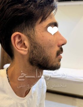 چند ماه پس از جراحی بینی