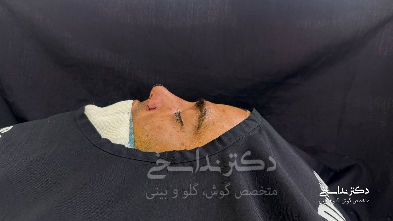 بعد از عمل