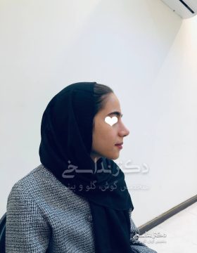 چند ماه پس از عمل بینی