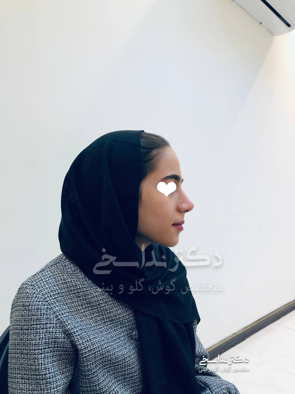 چند ماه پس از عمل بینی