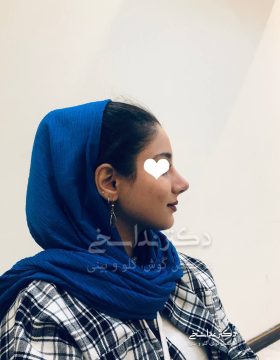 چند ماه پس از عمل بینی