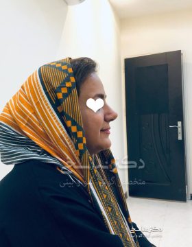 چند ماه پس از عمل بینی
