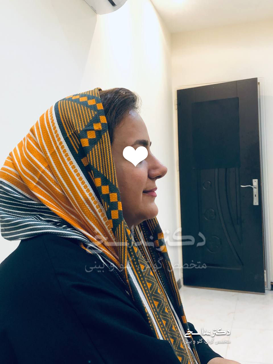 چند ماه پس از عمل بینی