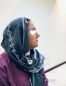 چند ماه پس از عمل بینی