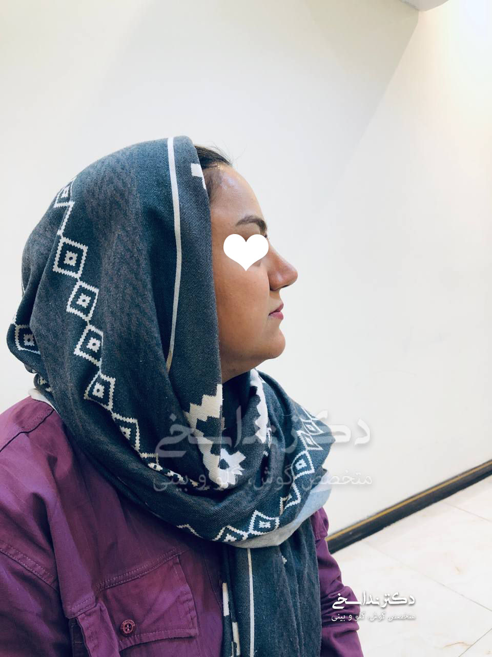 چند ماه پس از عمل بینی