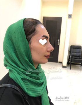 چند ماه پس از عمل بینی