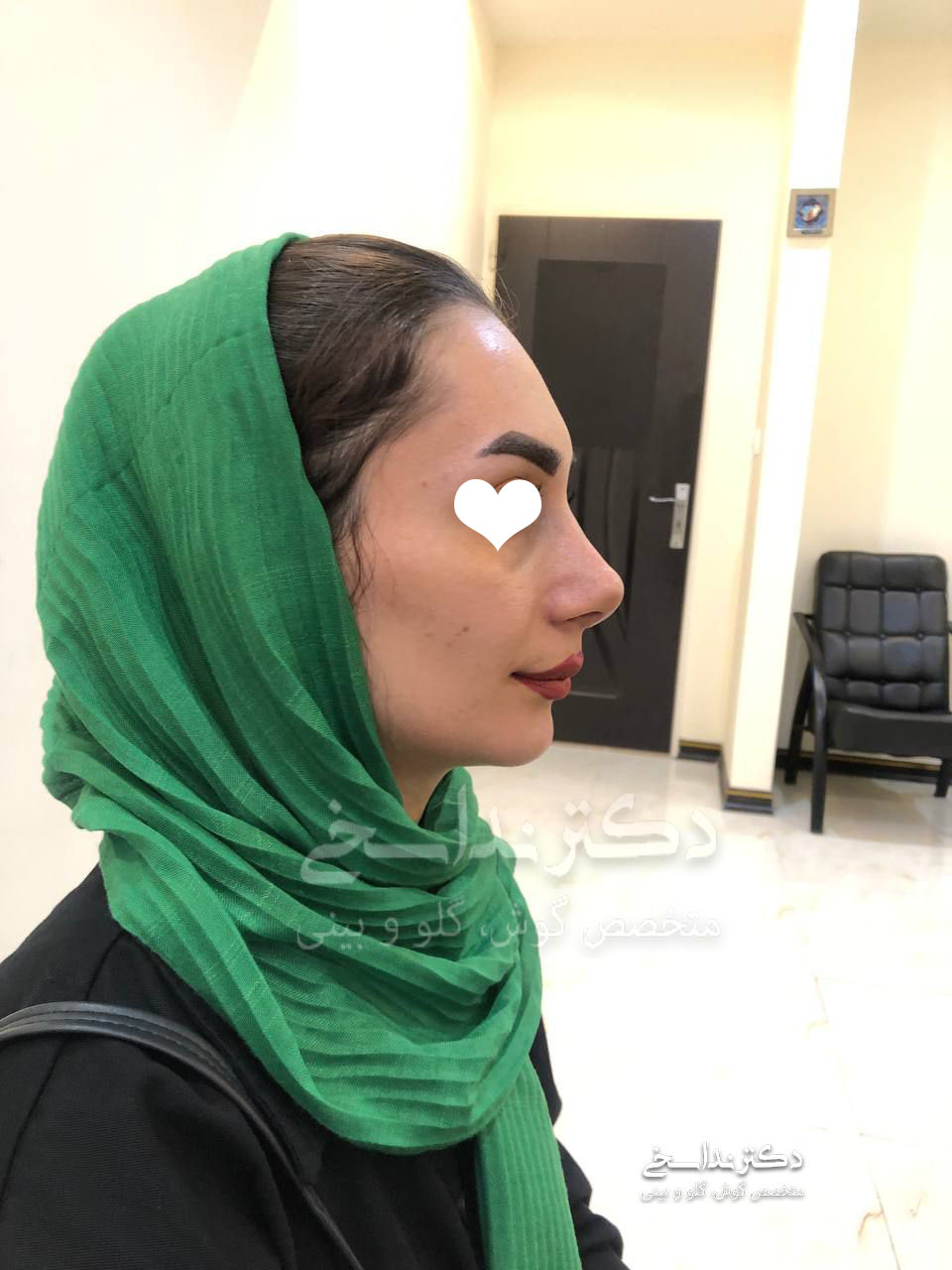 چند ماه پس از عمل بینی
