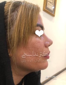 چند ماه پس از عمل بینی