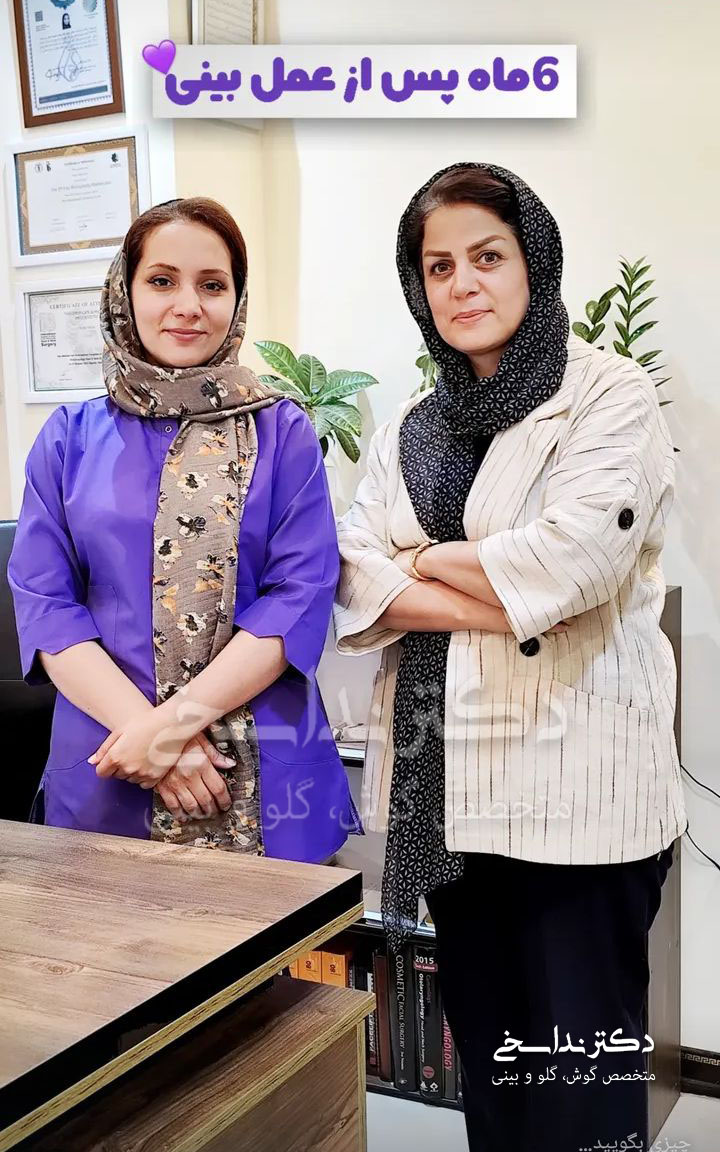 6 ماه پس از عمل بینی