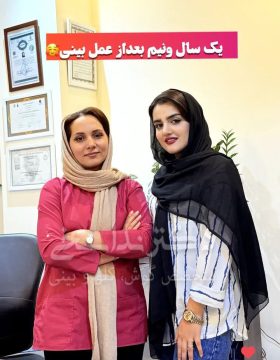 چند ماه بعد از عمل بینی