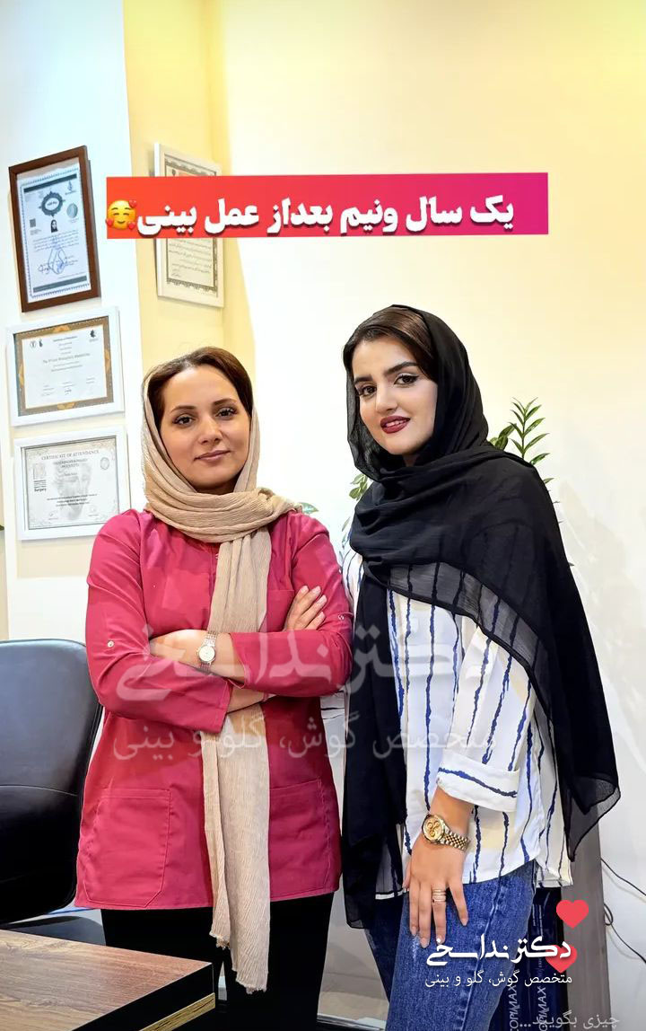 چند ماه بعد از عمل بینی