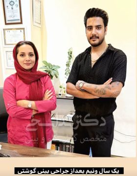 چند ماه بعد از عمل بینی